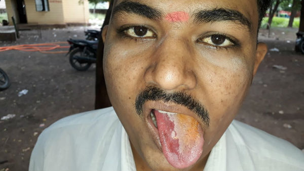 Youth Burnt His Tongue By Eating Chips In Vijayapura Youth Burnt His Tongue By Eating Chips In Vijayapura