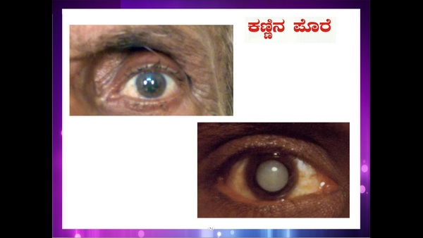  ರವೆಗಣ್ಣು ರೋಗ ಎಂದರೆ ಏನು?