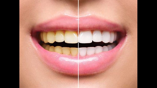 ಹಲ್ಲುಗಳ ಮೇಲೆ ಪರಿಣಾಮ ಬೀರುವ ದುಶ್ಚಟಗಳು