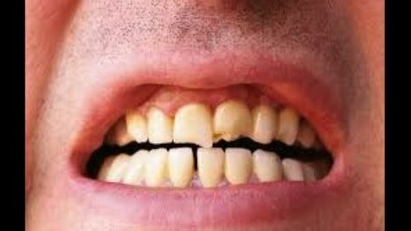 ಹಲ್ಲನ್ನು ಹುಳುಕುರೋಗದಿಂದ ಕಾಪಾಡಿಕೊಳ್ಳಬೇಕು