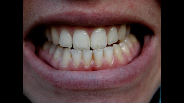 ಬಾಯಿಯ ಸ್ವಚ್ಛತೆಗೆ ಆದ್ಯತೆ ನೀಡಿ