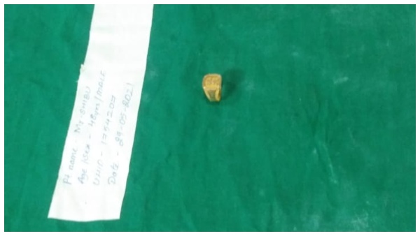  Mangaluru: Thief Who Swallowed A Gold Ring To Escape From The Police