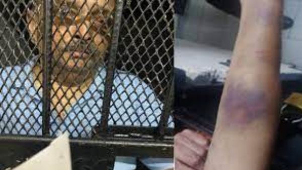 ಮೆಹುಲ್ ಚೋಕ್ಸಿ ದೇಹದಲ್ಲಿ ಗಾಯದ ಗುರುತು 