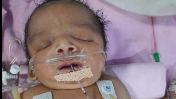 Help 6 Month Old Baby Affected With Treacher Collins Syndrome 