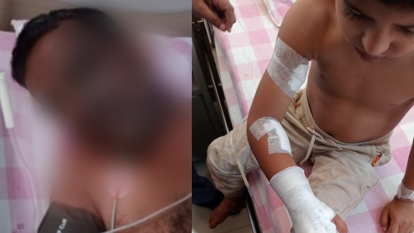 Bengaluru: Father and Son Seriously Injured after coming in contact with high tension wire in Puttenahalli Bengaluru: Father and Son Seriously Injured after coming in contact with high tension wire in Puttenahalli