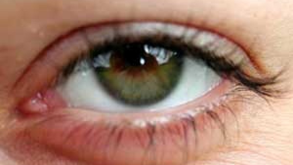  ಗ್ಲುಕೋಮಾದ ಲಕ್ಷಣಗಳು