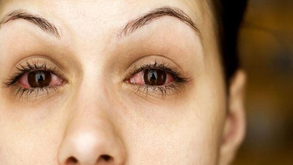  ಕಣ್ಣಿನ ಪೊರೆ ತಡೆಗಟ್ಟುವಿಕೆ