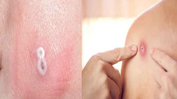 ಏನಿದು ಮಂಕಿಪಾಕ್ಸ್ ವೈರಸ್, ಯಾರಿಗೆ ಅಪಾಯ? 