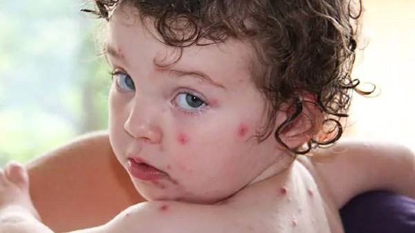 ಟೊಮೇಟೊ ಜ್ವರ ಎಂದರೇನು? 