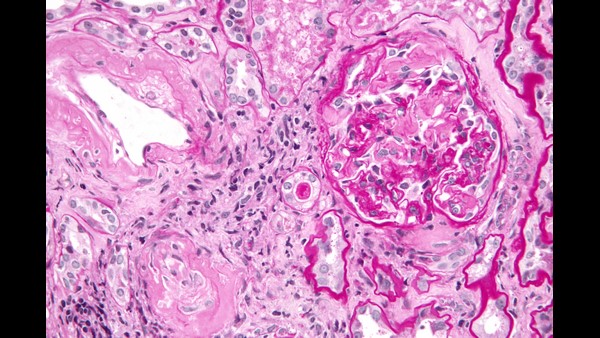 ಏನಿದು ಅಮಿಲೋಯ್ಡೋಸಿಸ್? 