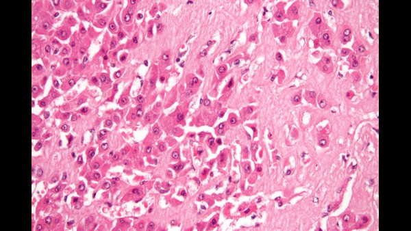 ಅಮಿಲಾಯ್ಡೋಸಿಸ್ ಎನ್ನುವುದು ಒಬ್ಬರಿಂದ ಒಬ್ಬರಿಗೆ ಹರಡುವುದಿಲ್ಲ 