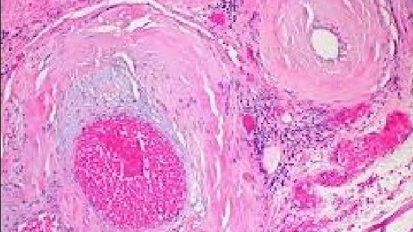 ಅಮಿಲೋಯ್ಡೋಸಿಸ್ ಸಮಸ್ಯೆಗೆ ಹೇಗಿರುತ್ತೆ ಚಿಕಿತ್ಸೆ? 