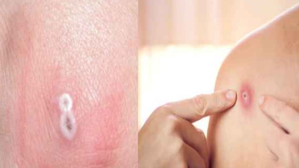  ತಡೆಗಟ್ಟುವ ವಿಧಾನಗಳು 