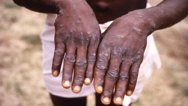 Ghaziabad: Monkeypox trait in a 5-year-old girl, sample for testing