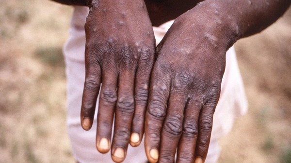 Monkeypox symptoms were detected in a person who had come to Telangana from Kuwait
