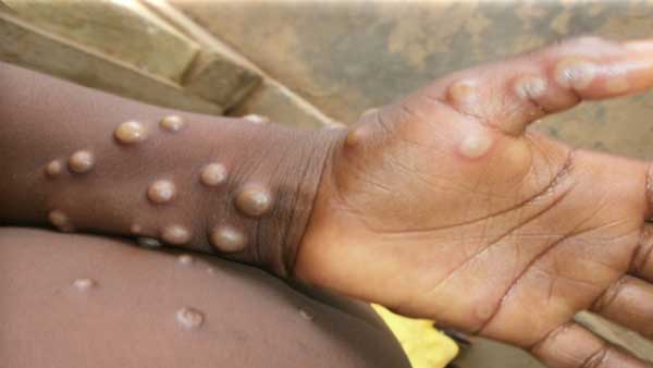 Breaking: Monkeypox: Central advice to screen international passengers 