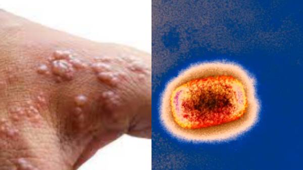  ಜಾಗತಿಕವಾಗಿ ಆರೋಗ್ಯ ತುರ್ತುಸ್ಥಿತಿ