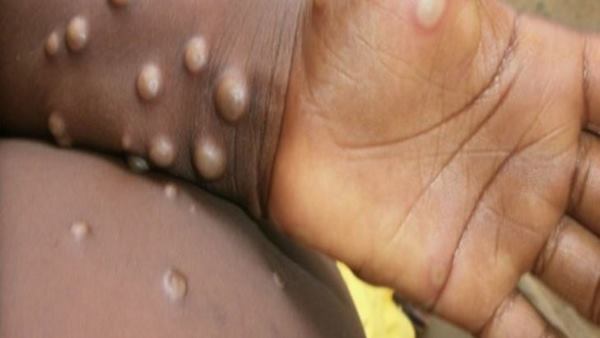  ಮಂಕಿಪಾಕ್ಸ್‌ ಹೇಗೆ ಕಾಣಿಸಿಕೊಳ್ಳುತ್ತದೆ?