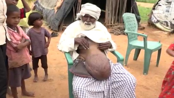 An old man from Gadag suffering a tumor in the abdominal mass in last 15 year