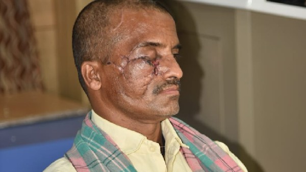 A man badly injured by bear bite had successful surgery at Hubballi Kims