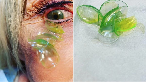 Doctor removes 23 contact lenses from old womans eye Doctor removes 23 contact lenses from old womans eye