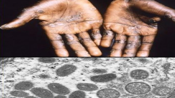 WHO Renames monkeypox as Mpox