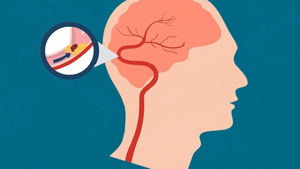 ಸ್ಟ್ರೋಕ್ ಅಪಾಯದ ಪ್ರಮಾಣ