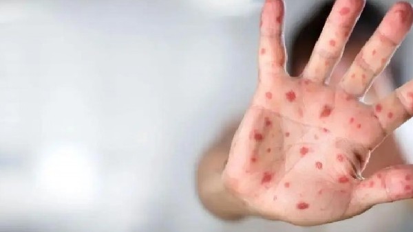 ದಡಾರ ತಡೆಗಟ್ಟುವ ಕ್ರಮಗಳು