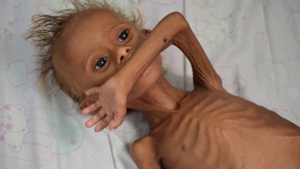 ಮಕ್ಕಳ ರಕ್ತಹೀನತೆ ಮಕ್ಕಳ ರಕ್ತಹೀನತೆ