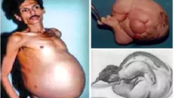 Fetus in Fetu: Rare Medical Condition Makes Nagpur Man Pregnant With Twin