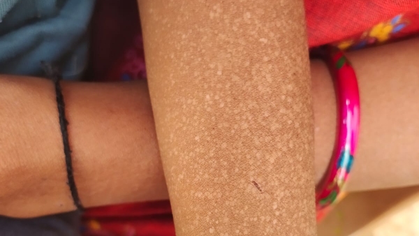 Deadly disease spotted in 4 childrens of hanur taluk