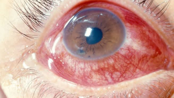 Eye virus infection increased in Davanagere district, What is suggestions of doctors?