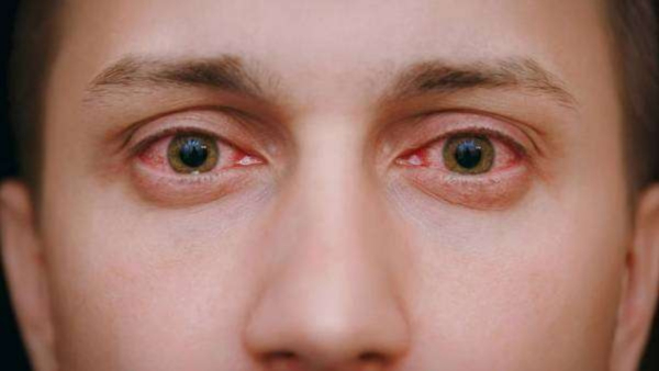 Pink eye: State Has Witnessed 40000 more Madras eye conjunctivitis cases reported in one week Pink eye: State Has Witnessed 40000 more Madras eye conjunctivitis cases reported in one week