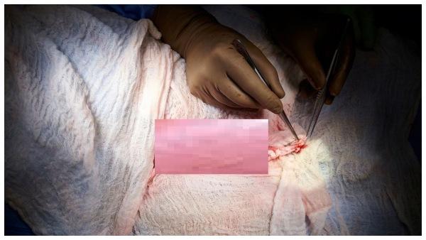 Another achievement in the medical world: A pigs kidney that functioned in a human body for a month!