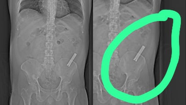 Manipal Hospital Doctors Successfully Removed Nail Cutter From Body