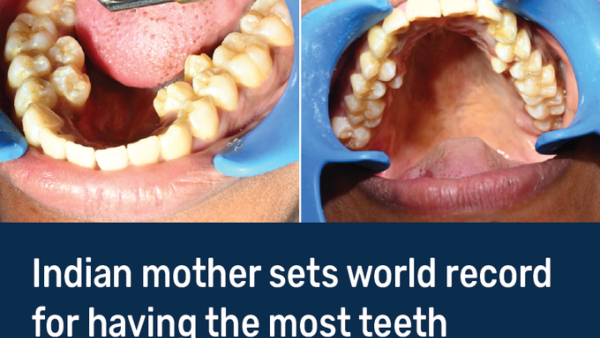 guinness-world-records-woman-with-38-teeth