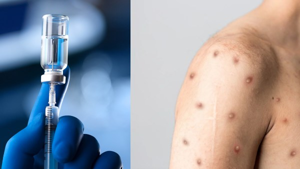 Indias 11 Lakh Children Have Not Taken of Measles 1st Dose Vaccine, Says WHO Report