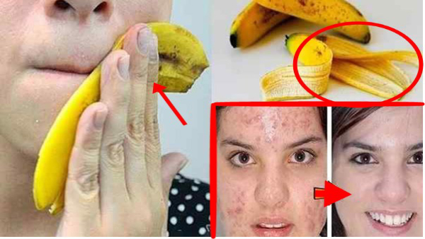 How to use banana peel for psoriasis treatment in kannada