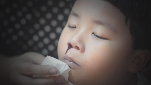 Nosebleed in Kids: What is the cause of nose bleeding in children?