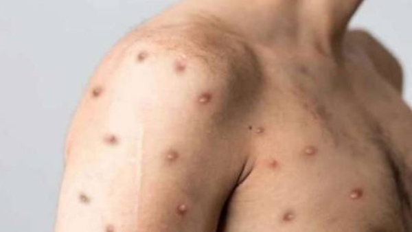 Why is chicken pox called Amma in India