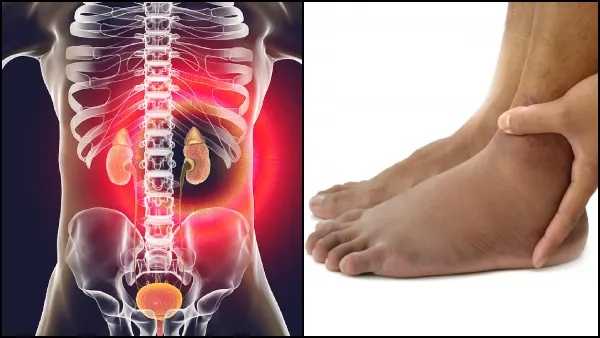 kidney disease symptoms in kannada signs of kidney disease on feet kidney disease symptoms in kannada signs of kidney disease on feet