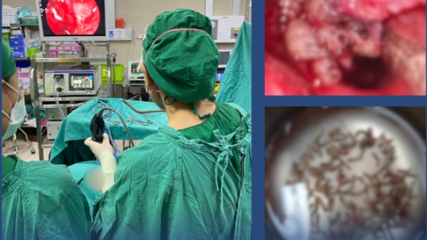 More Than 100 Live Insect Inside A Woman s Nose At Thailand