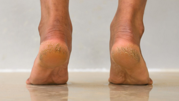 Health Tips Follow These Steps To Heal A Cracked Ankle