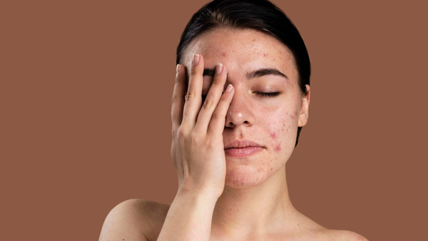 Health Tips How To Stop The Plucking Pimples