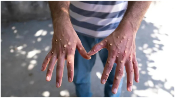 india suspected mpox case stable condition