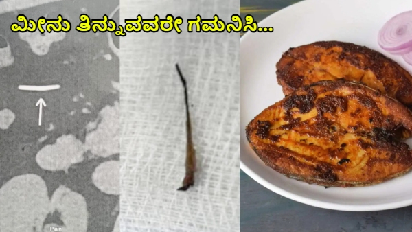 Removes Fish Bone from Patient s Stomach After 5 Years of Pain Fortis Hospital Doctors