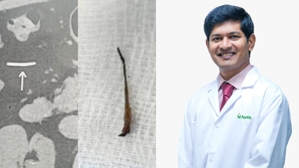 Removes Fish Bone from Patient s Stomach After 5 Years of Pain Fortis Hospital Doctors
