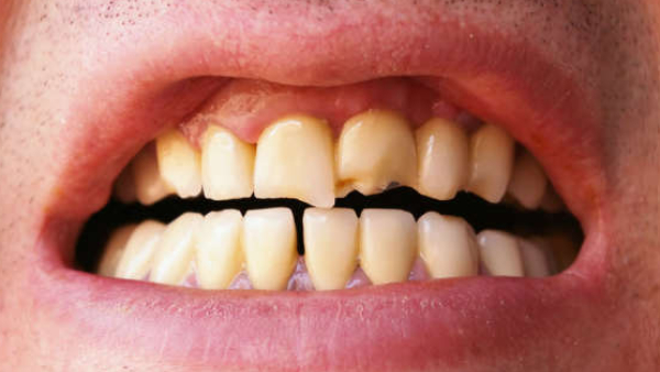 Health Tips What Are The Precautions To Be Taken For Teeth Care