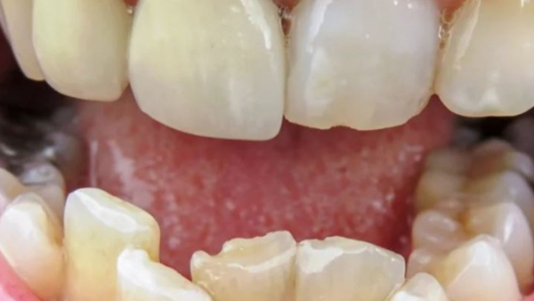 A teacher broke student s tooth at Bengaluru Fir A teacher broke student s tooth at Bengaluru Fir