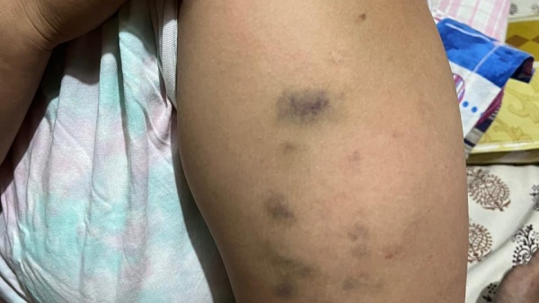 FIR Registered Against Dharmasthala PSI Kishor for Dowry Harassment and Assault